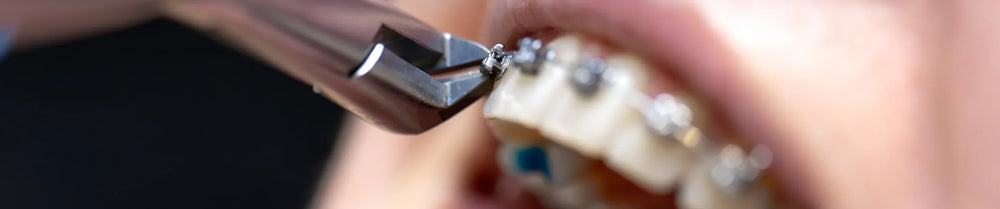 Braces and Aligners: How to Protect Enamel During Orthodontics